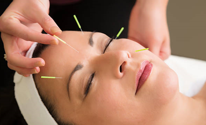 Acupuncture and Facial Rejuvenation